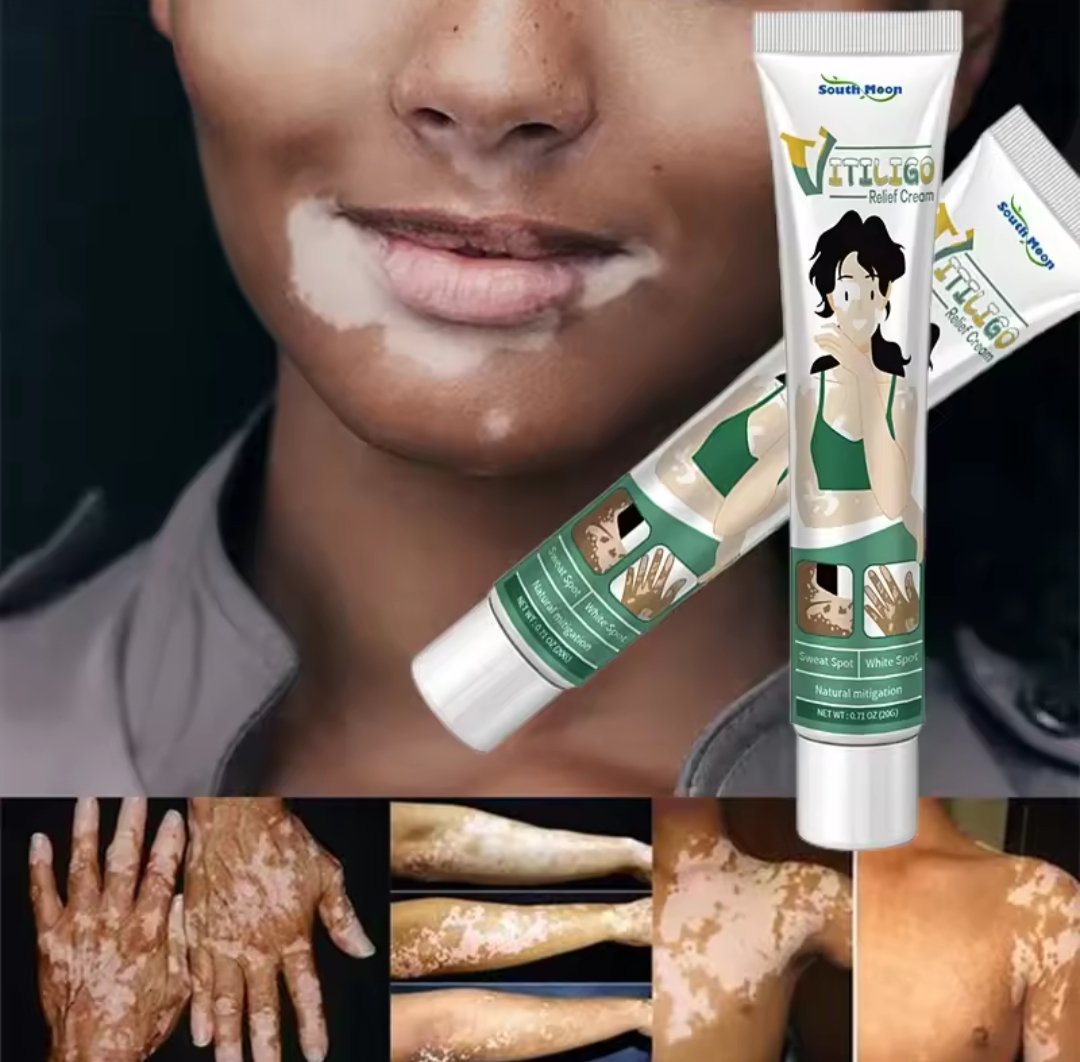 Vitiligo Ointment Herbal Extract Remove Ringworm White Spot