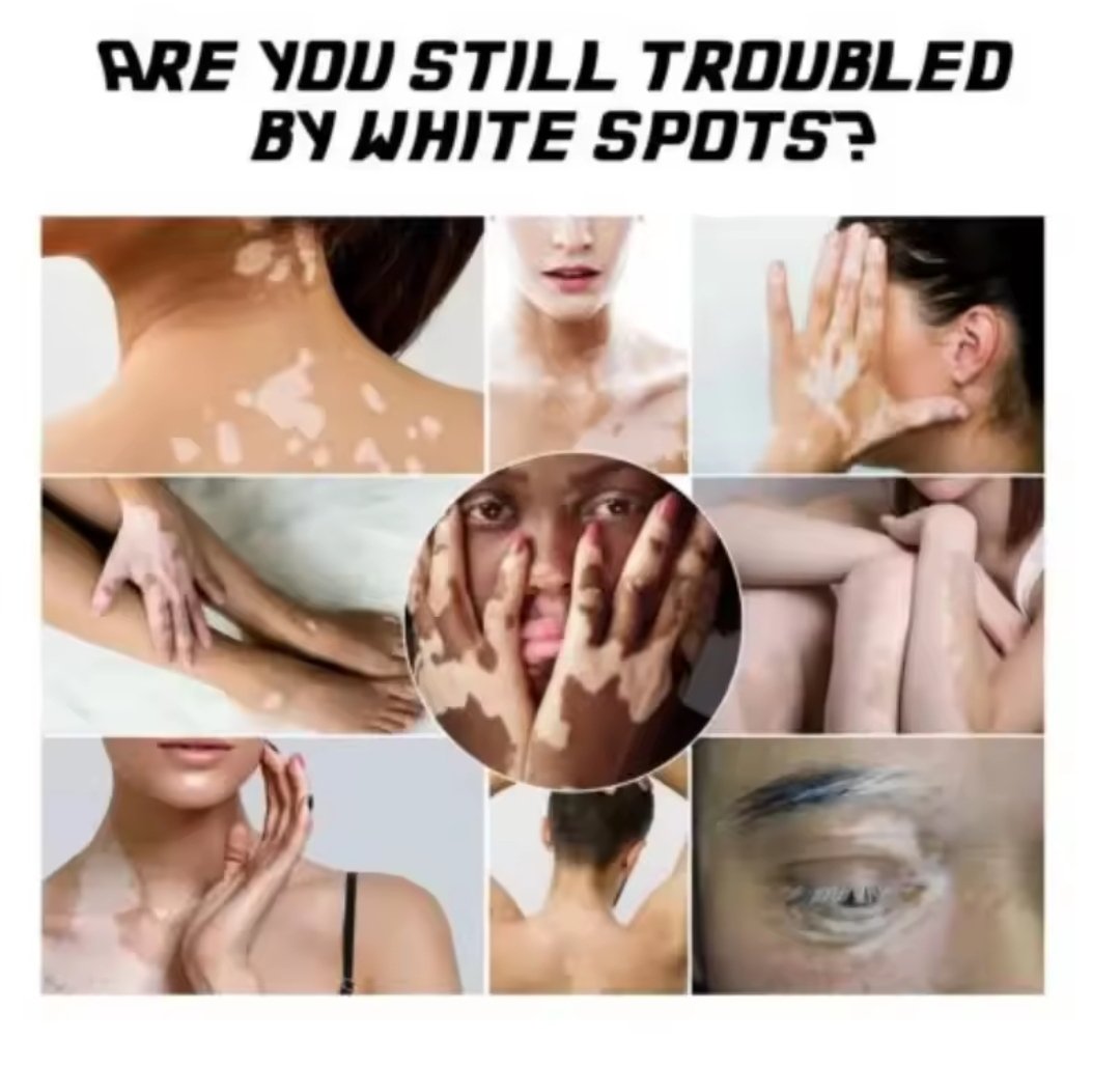 Vitiligo Ointment Herbal Extract Remove Ringworm White Spot - Image 3