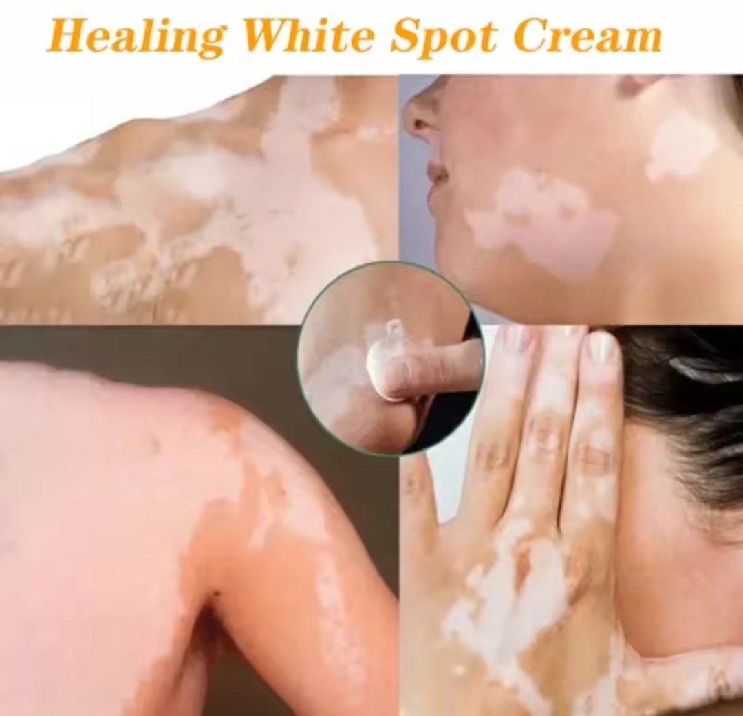 Vitiligo Ointment Herbal Extract Remove Ringworm White Spot - Image 2